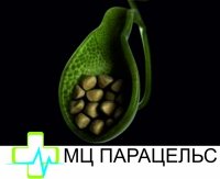ЖЕЛЧНОКАМЕННАЯ БОЛЕЗНЬ