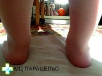 ВАЛЬГУСНАЯ ДЕФОРМАЦИЯ СТОПЫ
