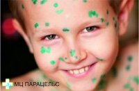 ВЕТРЯНКА У ДЕТЕЙ